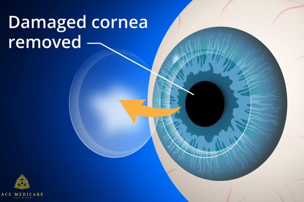 The Life-Changing Benefits of Cornea Transplants: Restoring Vision and Hope